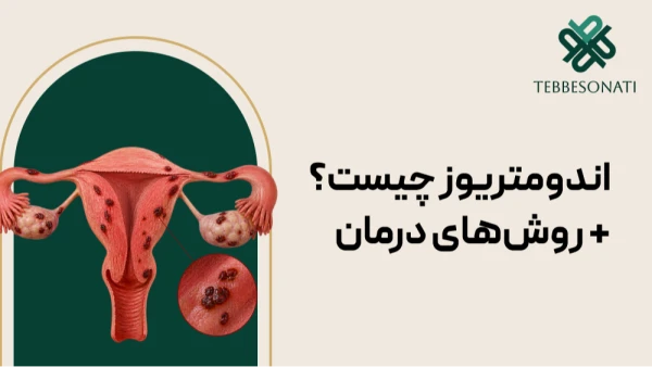 همه آنچه باید درباره اندومتریوز بدانید؛ علائم، علل، تشخیص و درمان