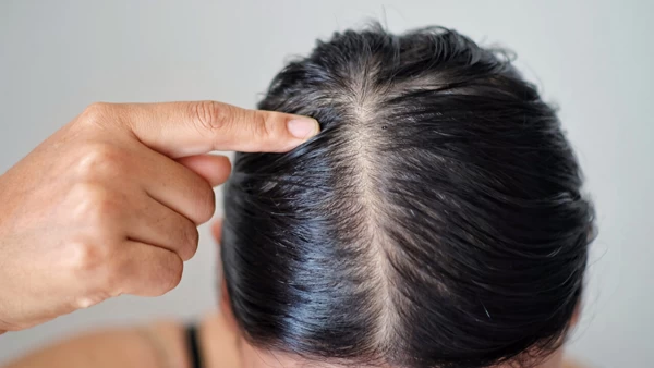 درمان چربی موی سر با روش‌های خانگی